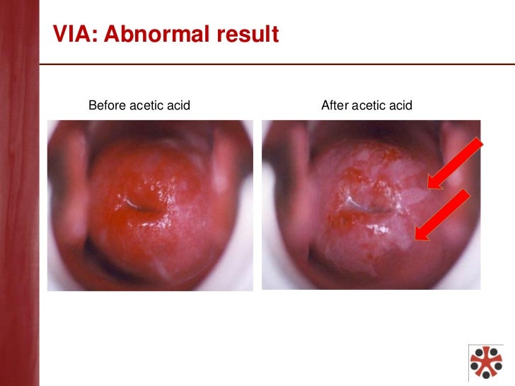Cervical cancer or ectropion endometrial cancer of the womb
