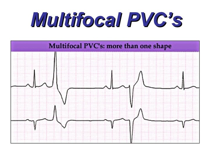 Ventricular Rhythms BMH/Tele