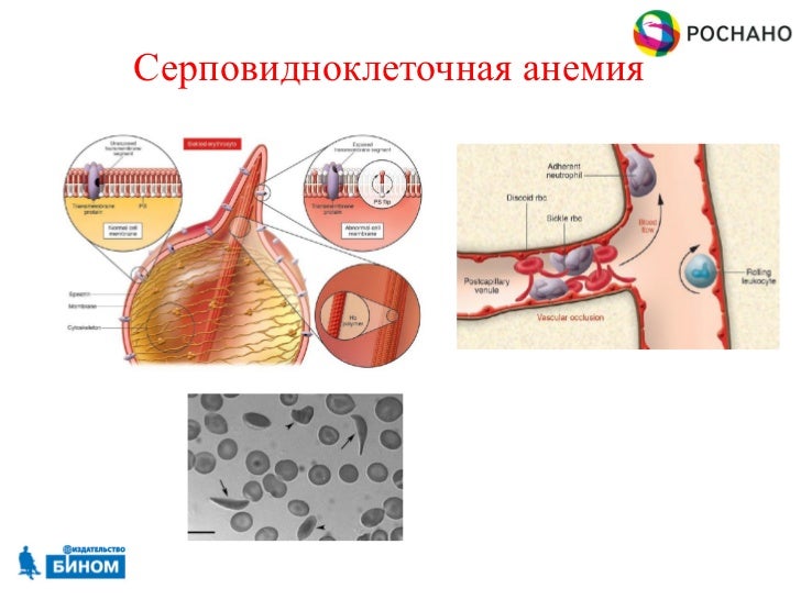 Серповидно-клеточная анемия фото