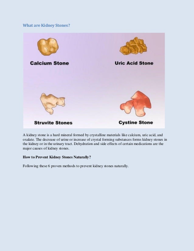Viagra And Uric Acid Stones