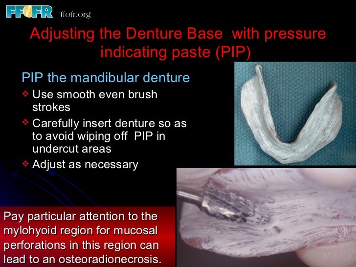 Complete Dentures for Irradiated Patients