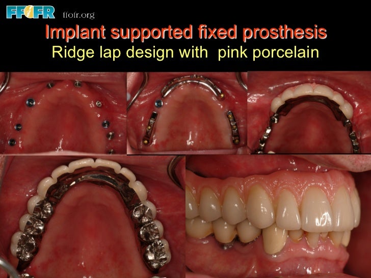Edentulous Maxilla Fixed Prostheses