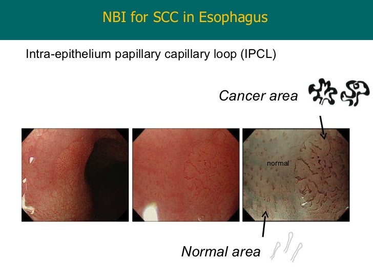 Endoscopy in Gastrointestinal Oncology Slide 7 I. Oda Chromosco…