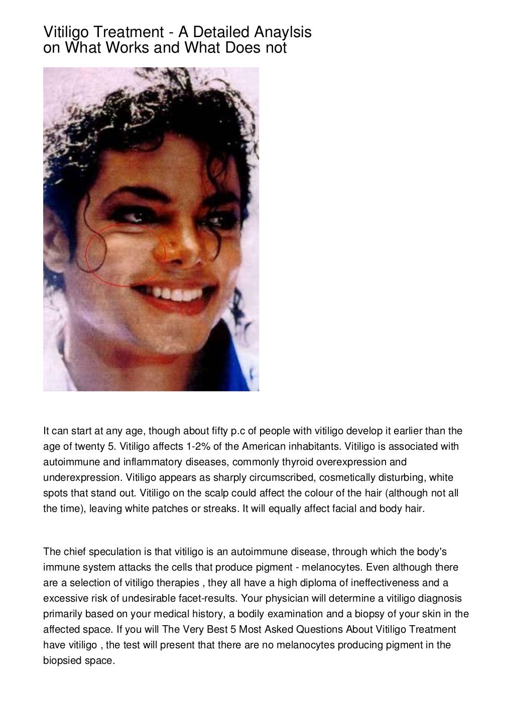 Vitiligo Treatment Diet : Vitiligo Beware Of White Patches On Your Skin