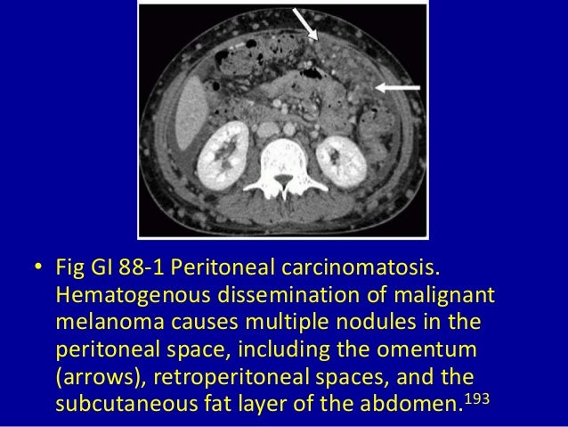 Asbestos can cause malignant mesothelioma prognosis