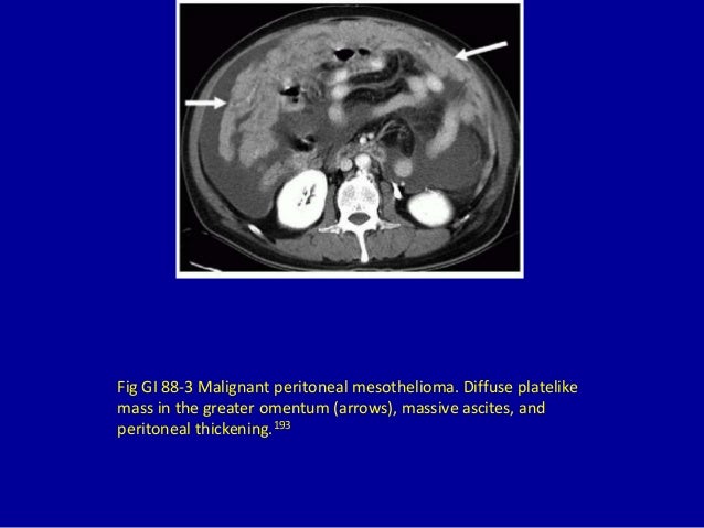 asbestos publicity signs sore throat publicity to asbestos and lung most cancers