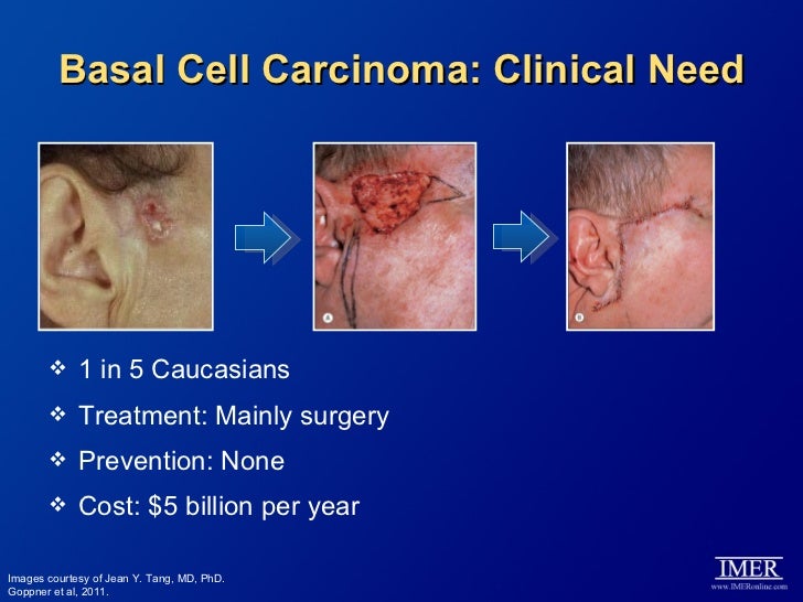 Targeted Therapy for the Treatment of Basal Cell Carcinoma