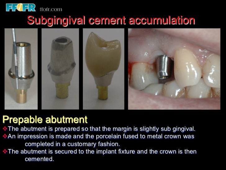 Abutment Selection