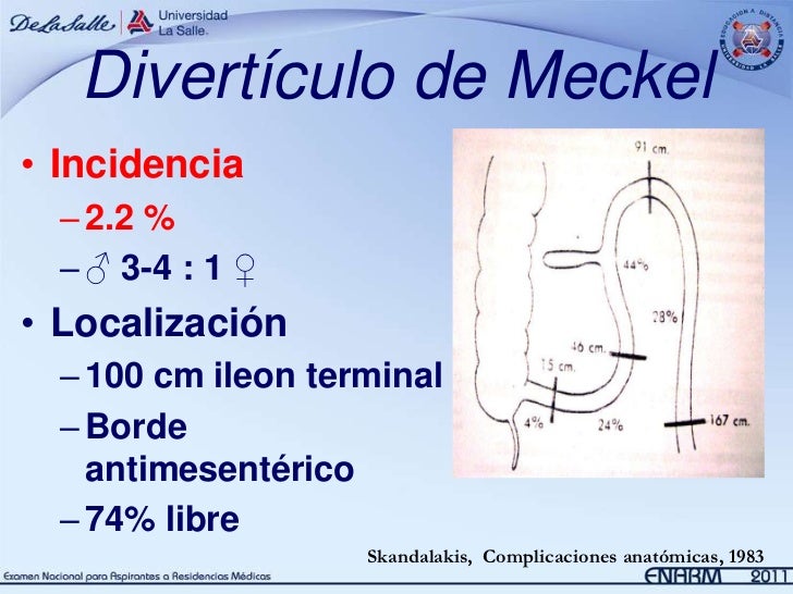 9. Divertículo de Meckel Pediatría
