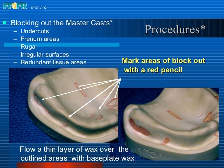 complete dentures record base and wax rim fabrication foundation altered cast technique