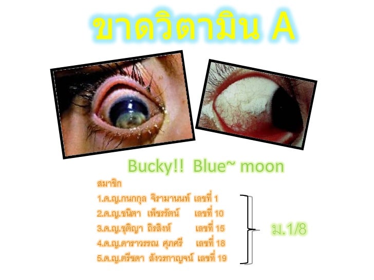 ขาดวิตามินเอ