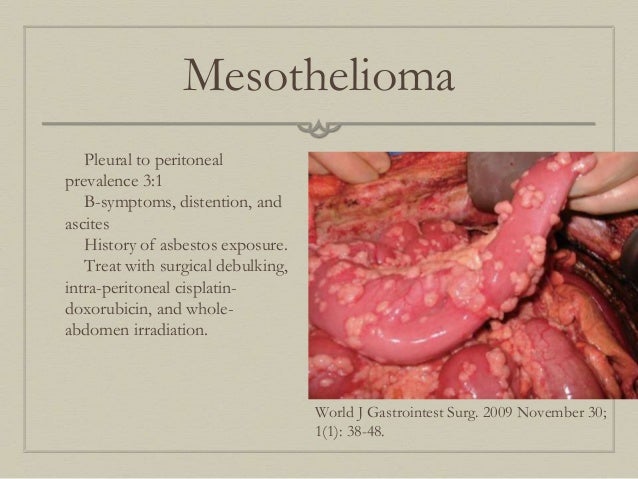 What's below asbestos siding malignant mesothelioma analysis