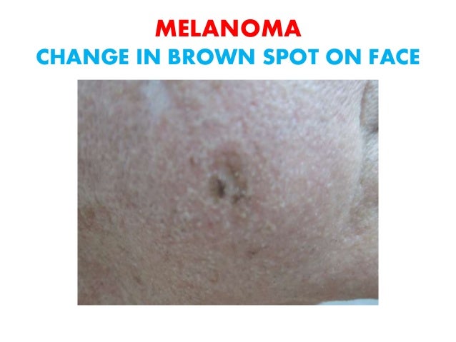Brown Spot On Face Cancer Pictures Michelle Rabinowitz Psy Picture