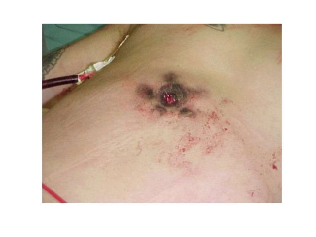 penetrating and blunt abdominal trauma Assessment of abdominal trauma requires the identification of immediately life-threatening injuries on primary survey, and delayed life threats on secondary survey most patients with significant penetrating injury require laparotomy there are differences in the management of projectiles (eg. penetrating and blunt abdominal trauma Assessment of abdominal trauma requires the identification of immediately life-threatening injuries on primary survey, and delayed life threats on secondary survey most patients with significant penetrating injury require laparotomy there are differences in the management of projectiles (eg.