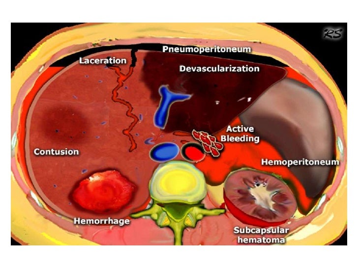 Abdominal trauma an overview