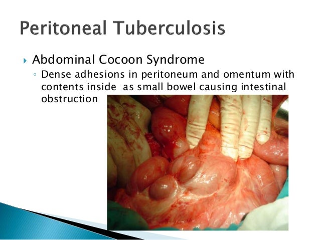 Picutes of tuberculosis