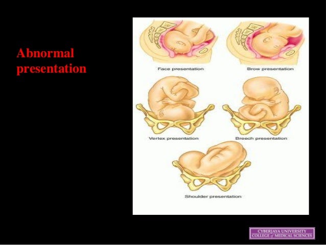 Transverse baby meaning picture