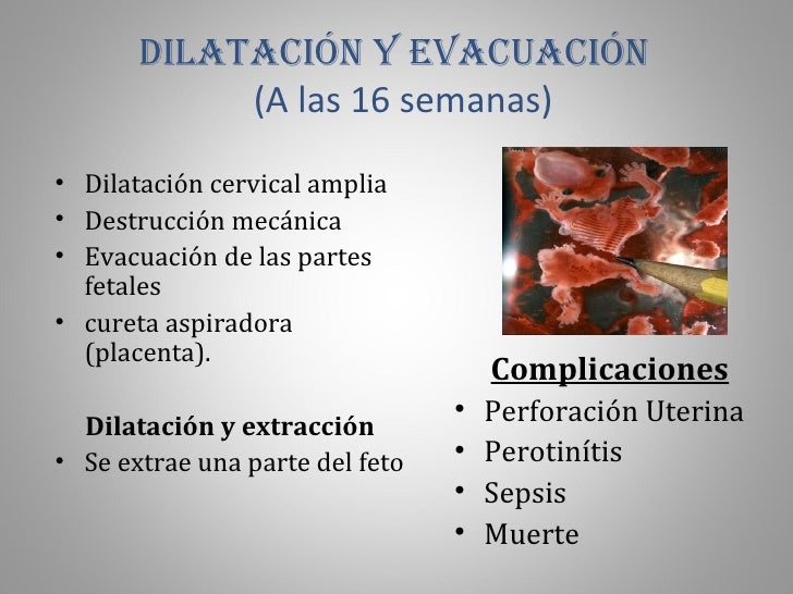Aborto expo obstetricia