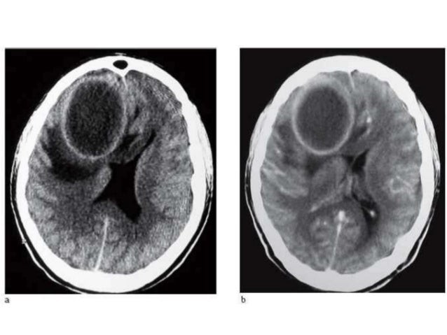 Absceso cerebral Absceso cerebral