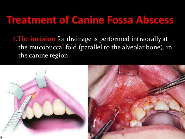 Abscess and phlegmon in maxillofacial region odontogenic infections-