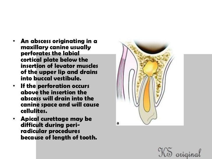 Access cavity preparation for maxillary canines