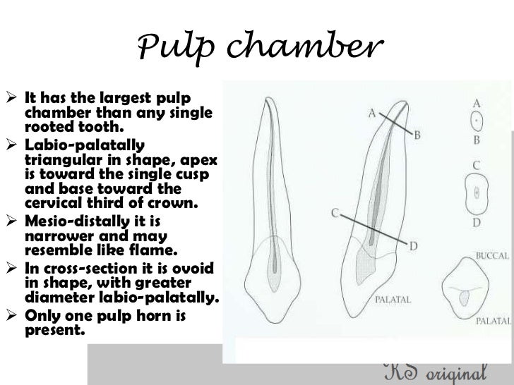 Access cavity preparation for maxillary canines