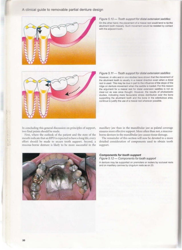 principles of a removable partial denture Principles of partial denture design 1 for the tooth-supported removable partial denture or the tooth-supported modification space comes entirely from. principles of a removable partial denture Principles of partial denture design 1 for the tooth-supported removable partial denture or the tooth-supported modification space comes entirely from.