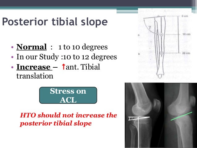 acl repair cyst anterior cruciate ligament sprain or tear