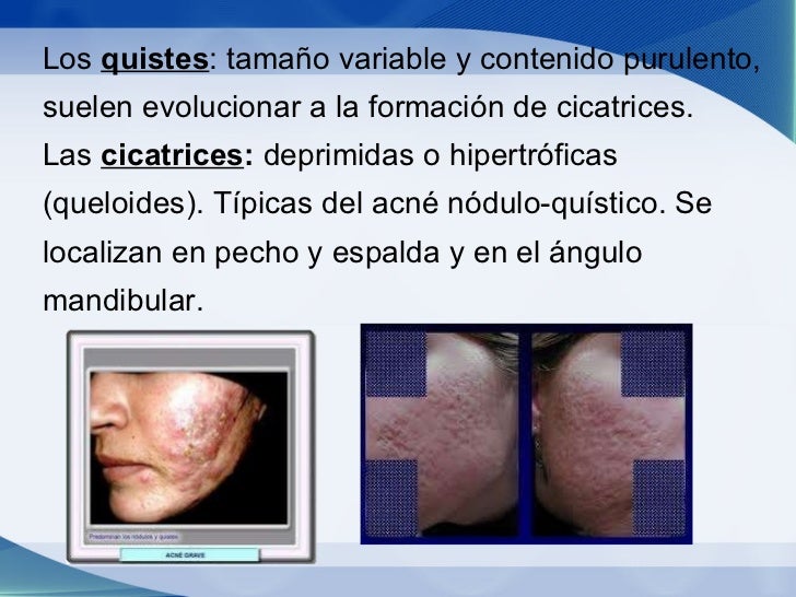 O que é um acne da pele de cara de uma foto e