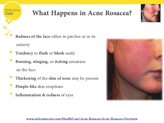 acne rosacea the disease its complications and acne causes chart
