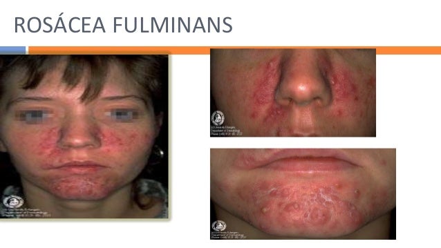 VIRTUAL GRAND ROUNDS IN DERMATOLOGY 2.0: Unilateral Facial ...