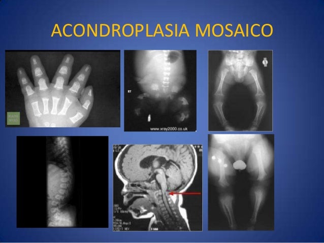Acondroplasia