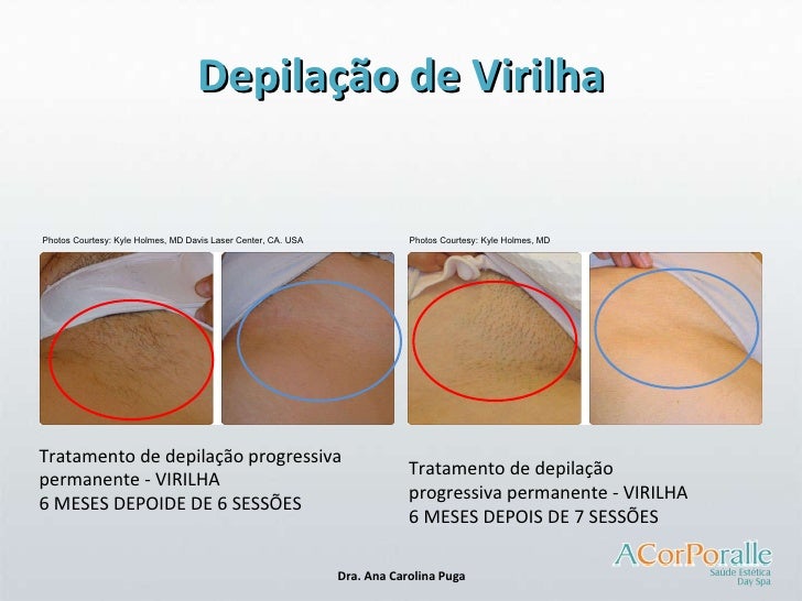 Depilacao a Laser - Acorporalle