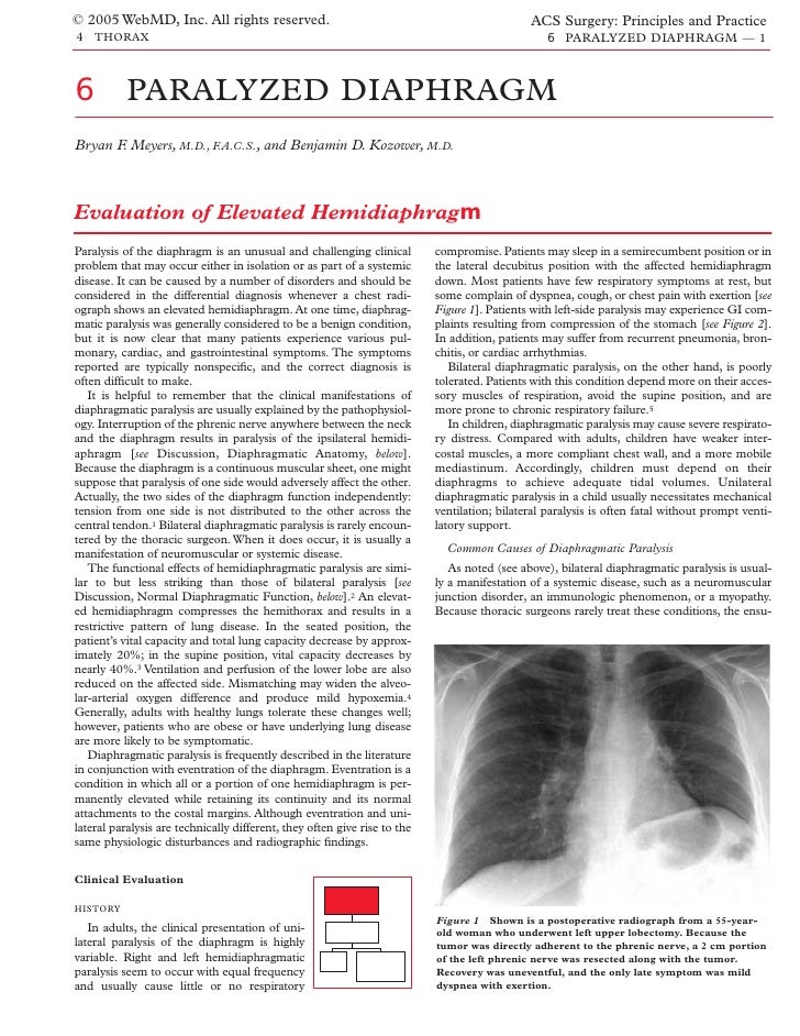 Acs0406 Paralyzed Diaphragm