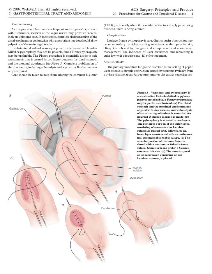 simple suture with omental patch simple suture with omental patch