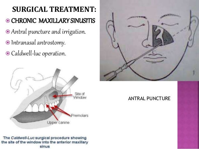 Acute Sinusitis pictures picture Acute Sinusitis