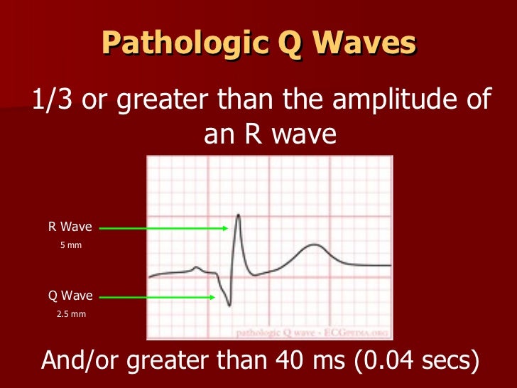 pathological q wave on ecg pathological q wave on ecg