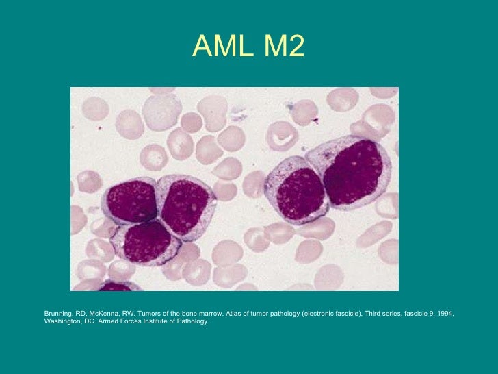 Aml leukemia prognosis in adults