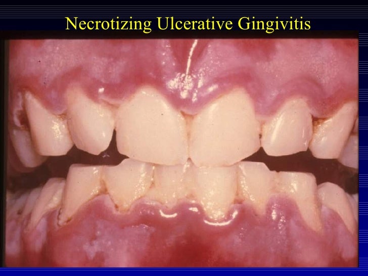 Gingivitis, Necrotizing Ulcerative; Stomatitis, Ulcerative; Trench Mouth; Vincent Angina
