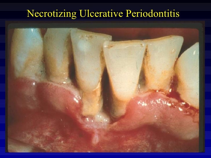 Necrotizing Periodontal Diseases - Foundations of ...