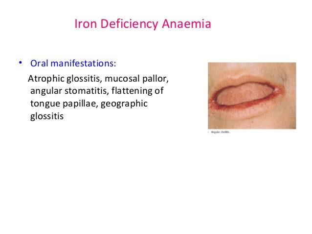 Atrophic Glossi...