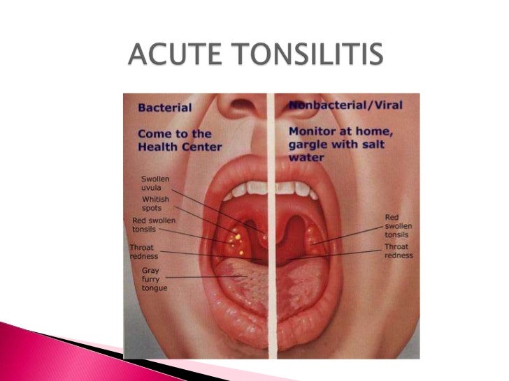 Catarrhal pharyngitis treatment zithromax Catarrhal pharyngitis treatment zithromax