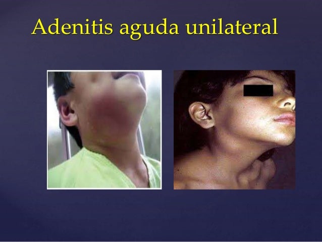 Adenitis Cervical