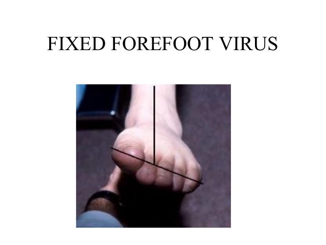 Flat Foot