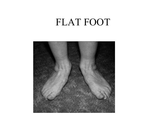 Acquired Flat Foot