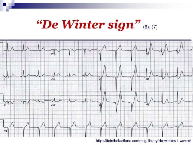 rbbb ecg