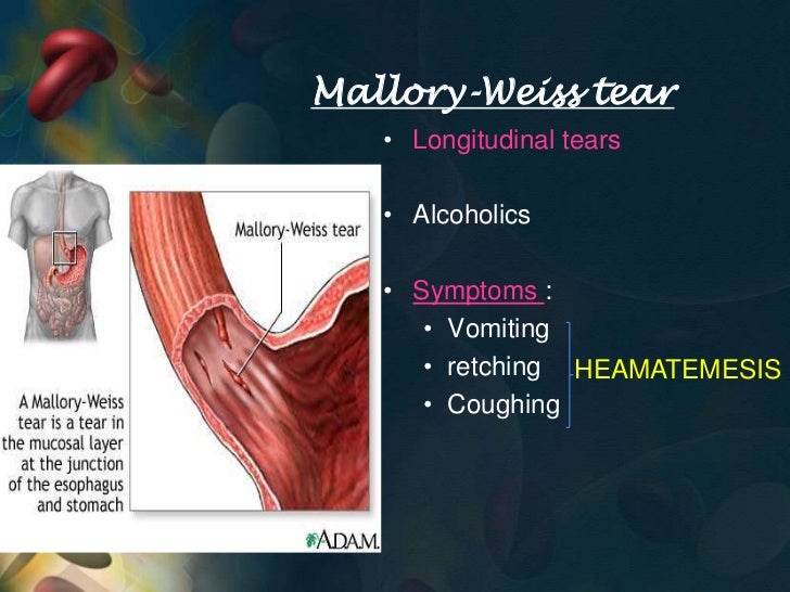 Aetiology of upper gi bleed