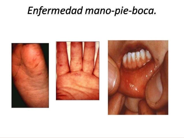 Que curar el magullado del dedo y la uña
