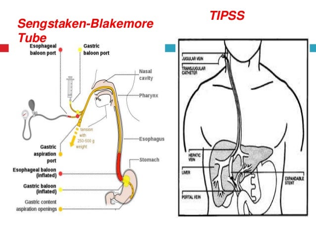 sengstaken blakemore tube