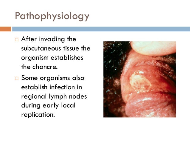 syphilis the great imitator Syphilis “the great imitator” syphilis is known as a bacterial infection that is caused by the spirochete bacterium treponema pallidum the primary way of. syphilis the great imitator Syphilis “the great imitator” syphilis is known as a bacterial infection that is caused by the spirochete bacterium treponema pallidum the primary way of.
